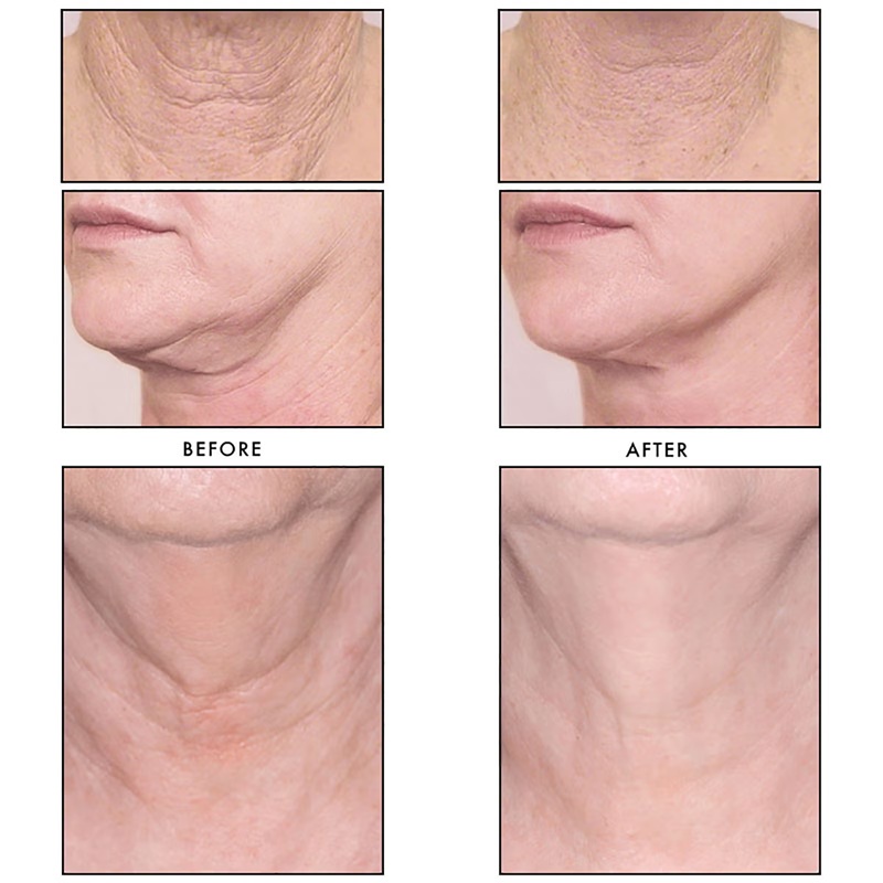 revision_skincare_nectfirm_advanced